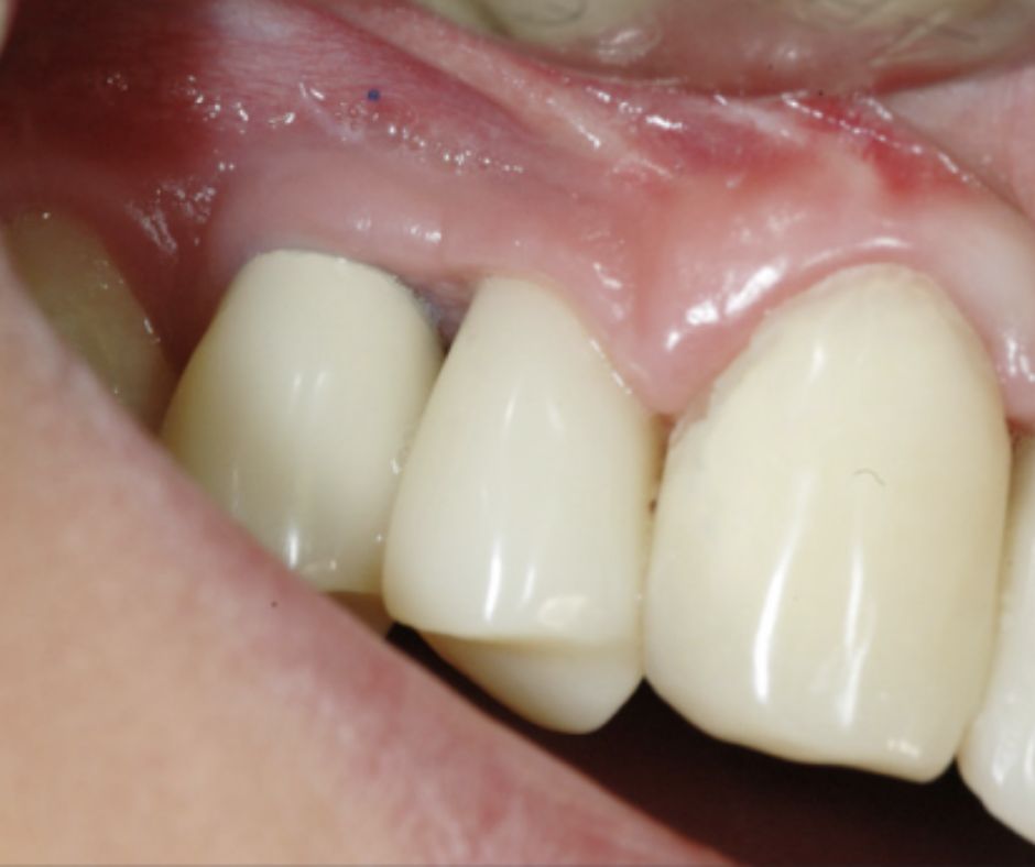 Case Report NeoGen Dr Hassfurther 11676_2