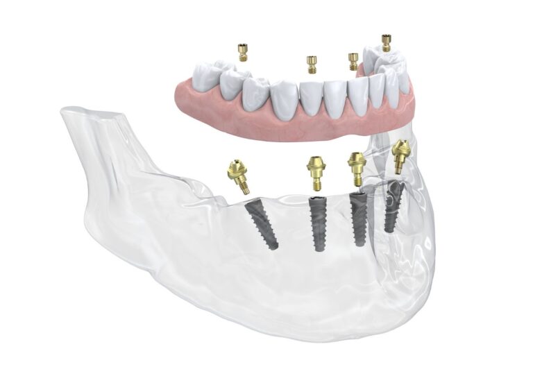 Neoss® Group announces the launch of a new Multi-Unit Abutment with their Neoss4+™ Treatment Solution
