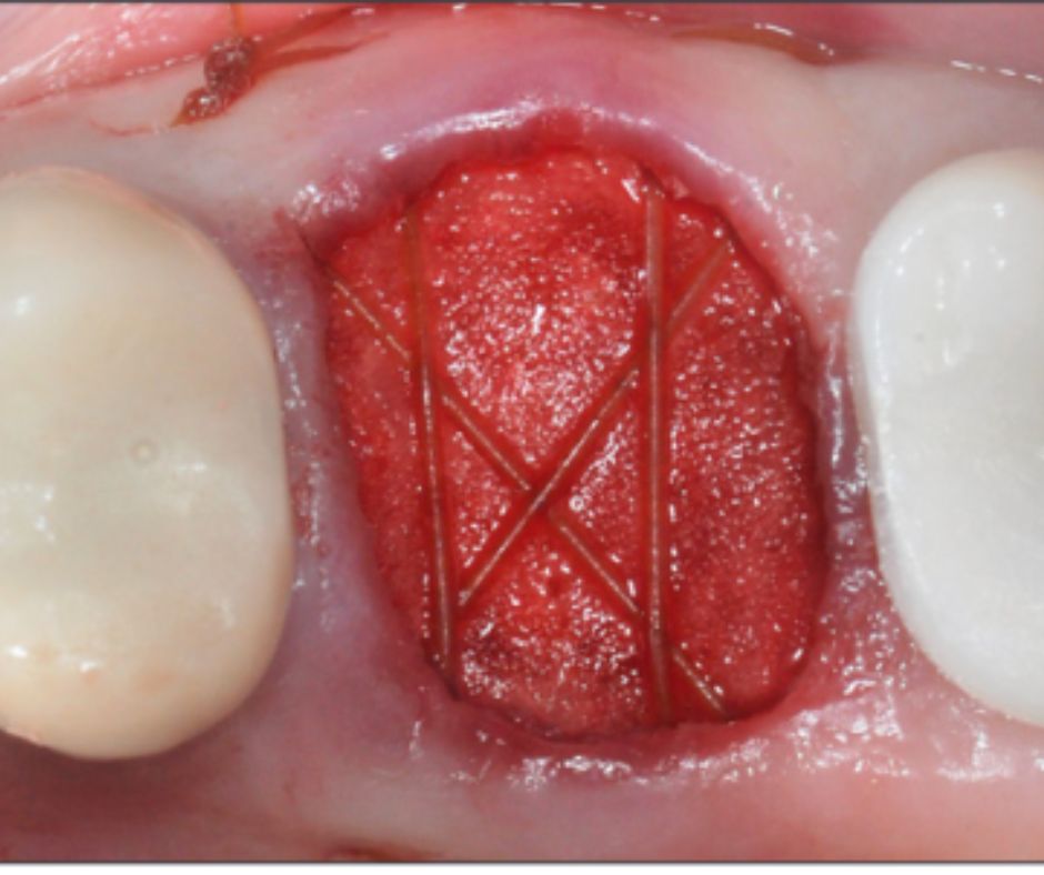 14679_0 Case Report Neoss Prosthetic procedure Dr R Gitter, D Haley